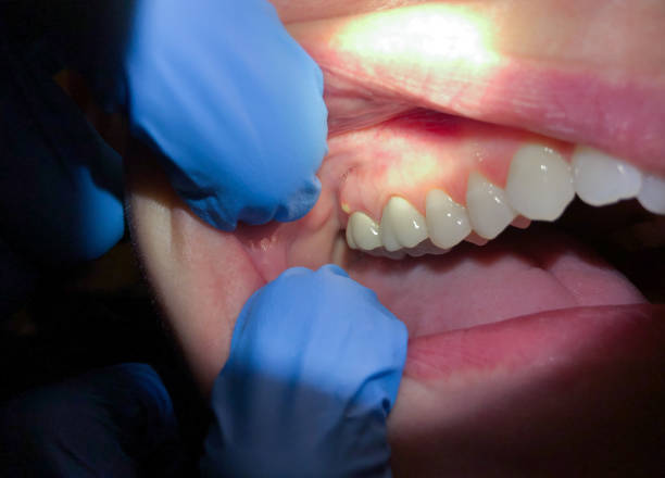Best Dentist for Tooth Abscess  in Curtice, OH